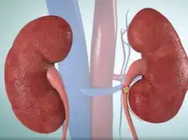 Best Foods for Kidney Stone Prevention