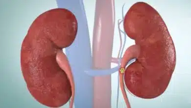 Best Foods for Kidney Stone Prevention