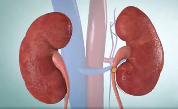 Best Foods for Kidney Stone Prevention