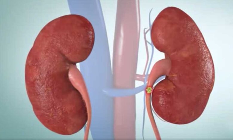 Best Foods for Kidney Stone Prevention