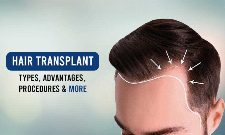 hair transplant as a permanent answer to baldness
