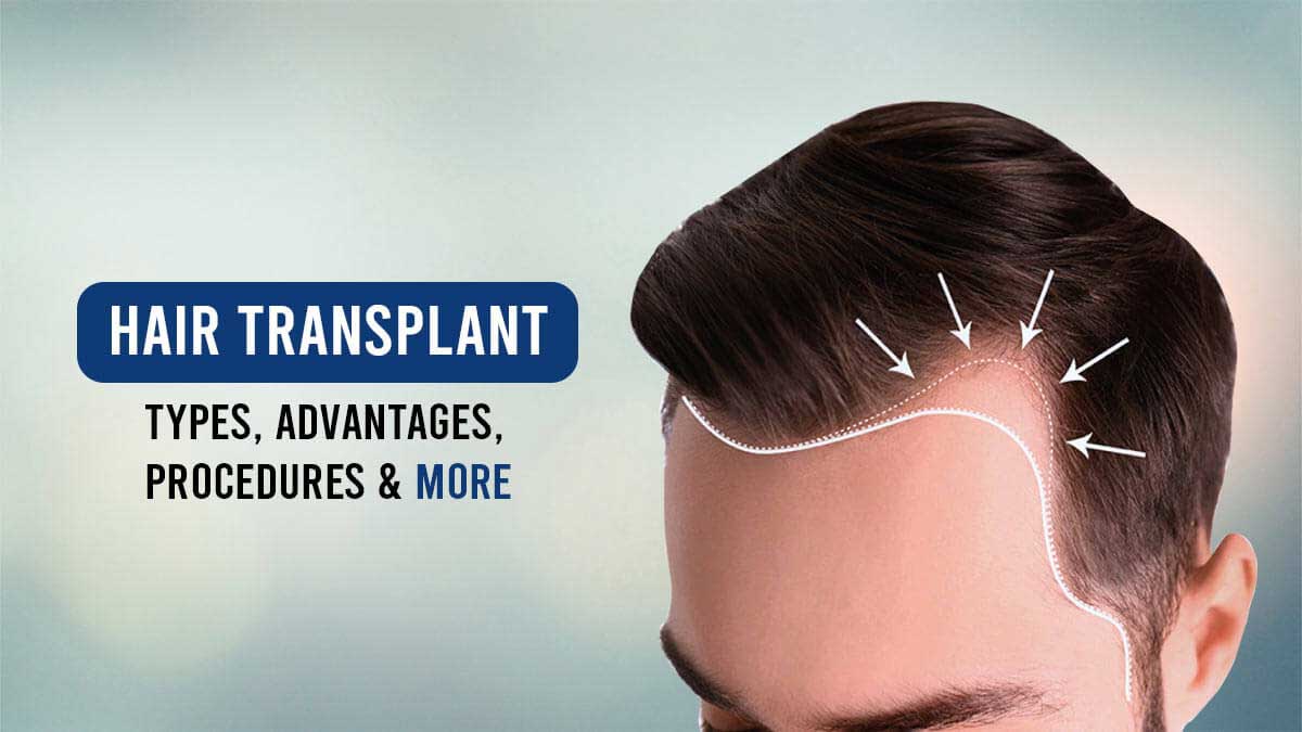 hair transplant as a permanent answer to baldness