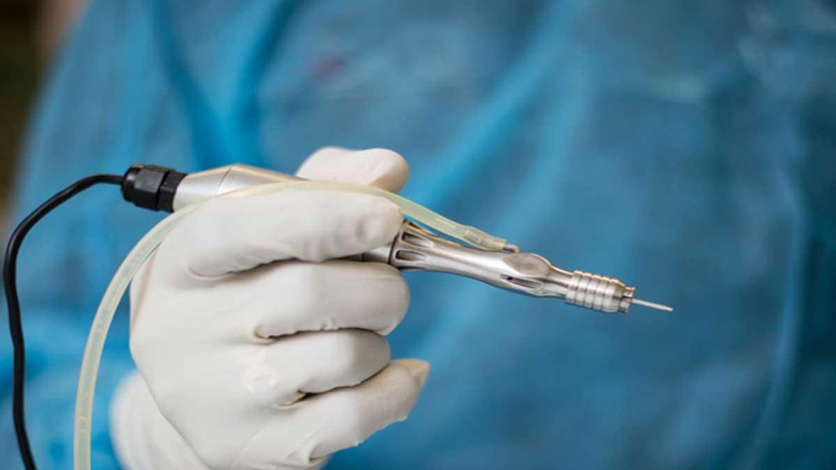 hair transplant as a permanent answer to baldness