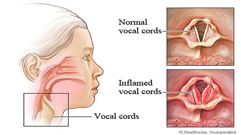 Reasons Symptoms and treatment of vocal abuse