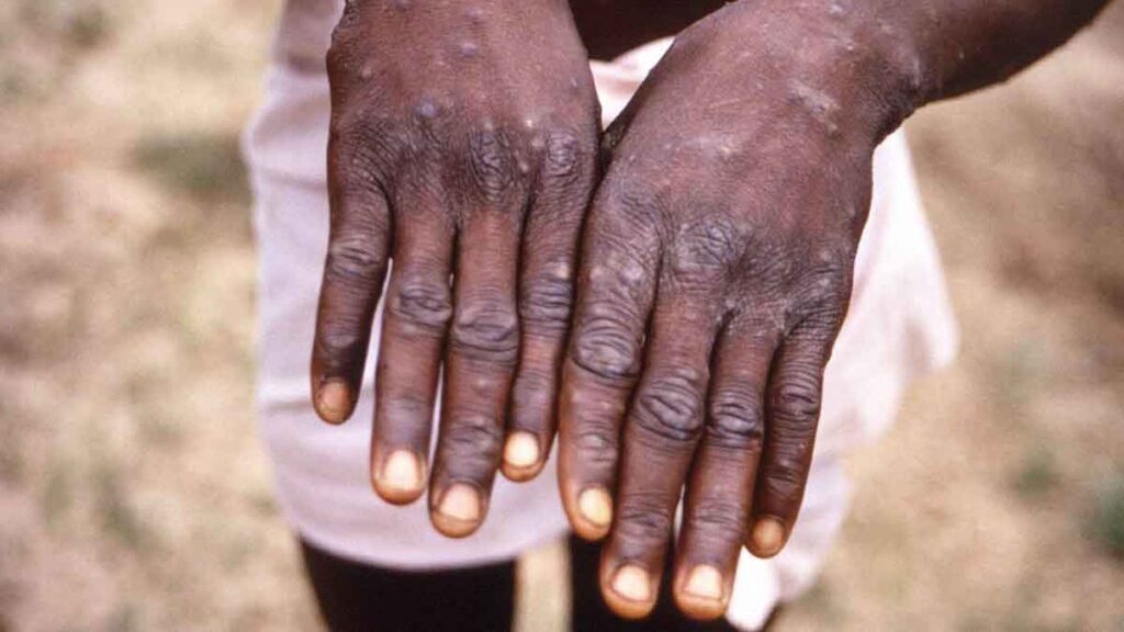 India's first Monkeypox case registered in Kerala
