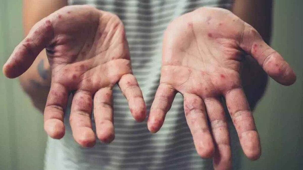 4 cases of monkeypox reported in India: Know about the disease