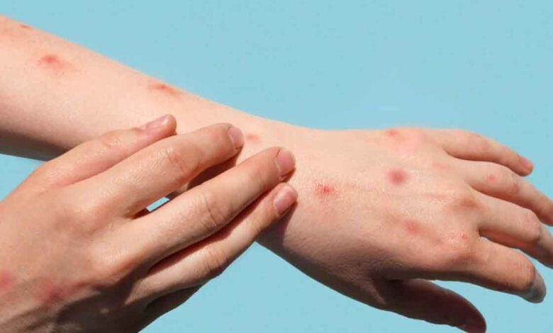 scrutiny of all international travellers for Monkeypox