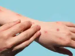 What are Monkeypox updates? Why a global concern?