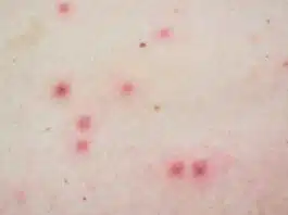 India's first Monkeypox case registered in Kerala