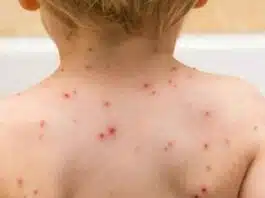 4 cases of monkeypox reported in India: Know about the disease