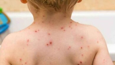 4 cases of monkeypox reported in India: Know about the disease