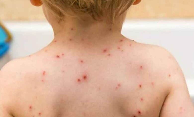 4 cases of monkeypox reported in India: Know about the disease