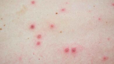 India's first Monkeypox case registered in Kerala