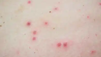 India's first Monkeypox case registered in Kerala