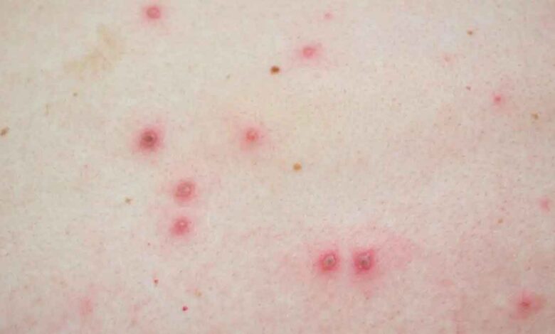 India's first Monkeypox case registered in Kerala
