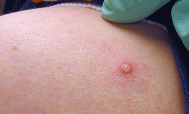 India's first monkeypox patient “Fully cured”