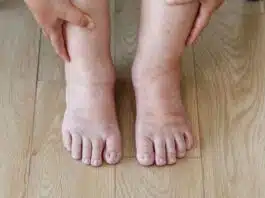 5 Home Remedies To Treat Swollen Feet