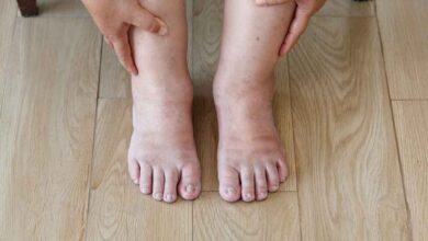 5 Home Remedies To Treat Swollen Feet