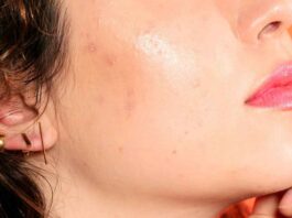 Acne, 7 Things from kitchen That Can Help Prevent It