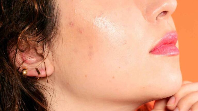 Acne से परेशान, 7 चीज़ें जो इसे रोकने में मदद कर सकती है