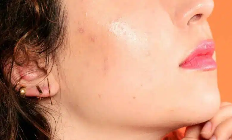 Acne, 7 Things from kitchen That Can Help Prevent It