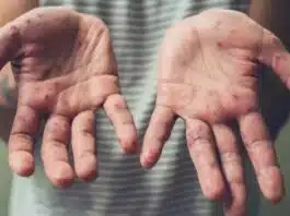 5th Monkeypox case reported in Kerala
