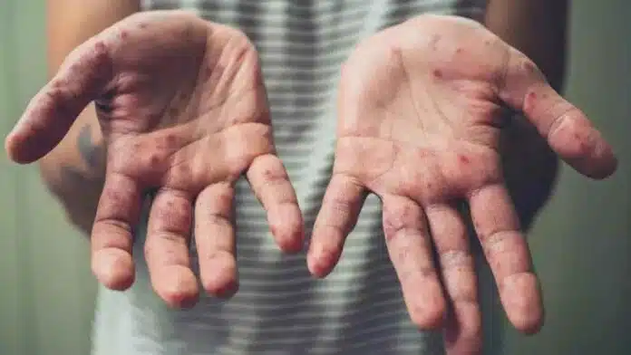 5th Monkeypox case reported in Kerala