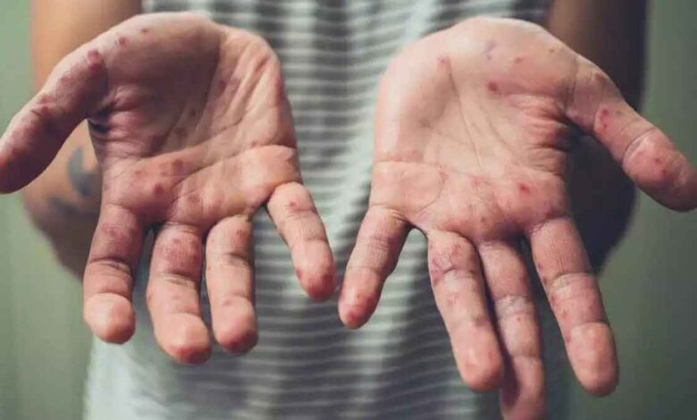 5th Monkeypox case reported in Kerala