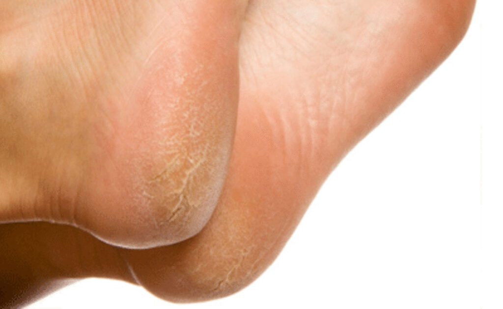 Home Remedies To Treat Cracked Heels