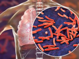 Symptoms, Diagnosis and Prevention of Latent Tuberculosis