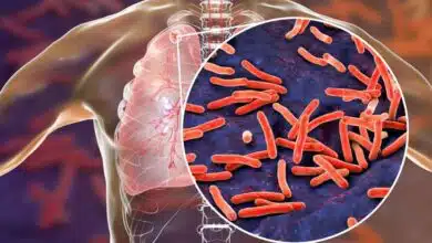 Symptoms, Diagnosis and Prevention of Latent Tuberculosis