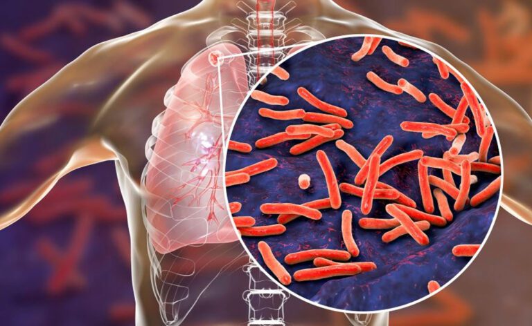 Latent Tuberculosis: लक्षण, निदान और रोकथाम के उपाय