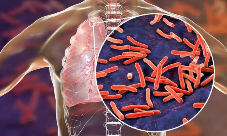 Symptoms, Diagnosis and Prevention of Latent Tuberculosis