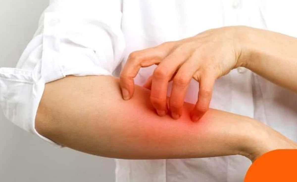 Mushroom allergy causes, symptoms and remedies