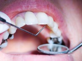 Try 7 Home Remedies To Get Rid Of Cavities