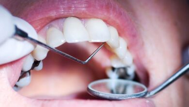 Try 7 Home Remedies To Get Rid Of Cavities