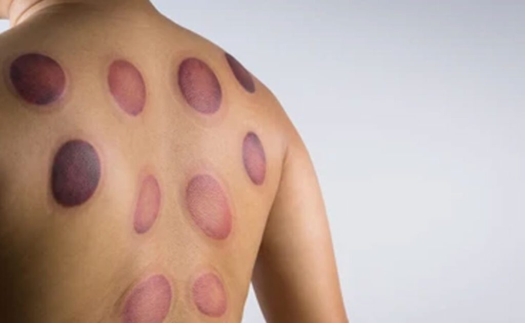 Important thing related to cupping therapy