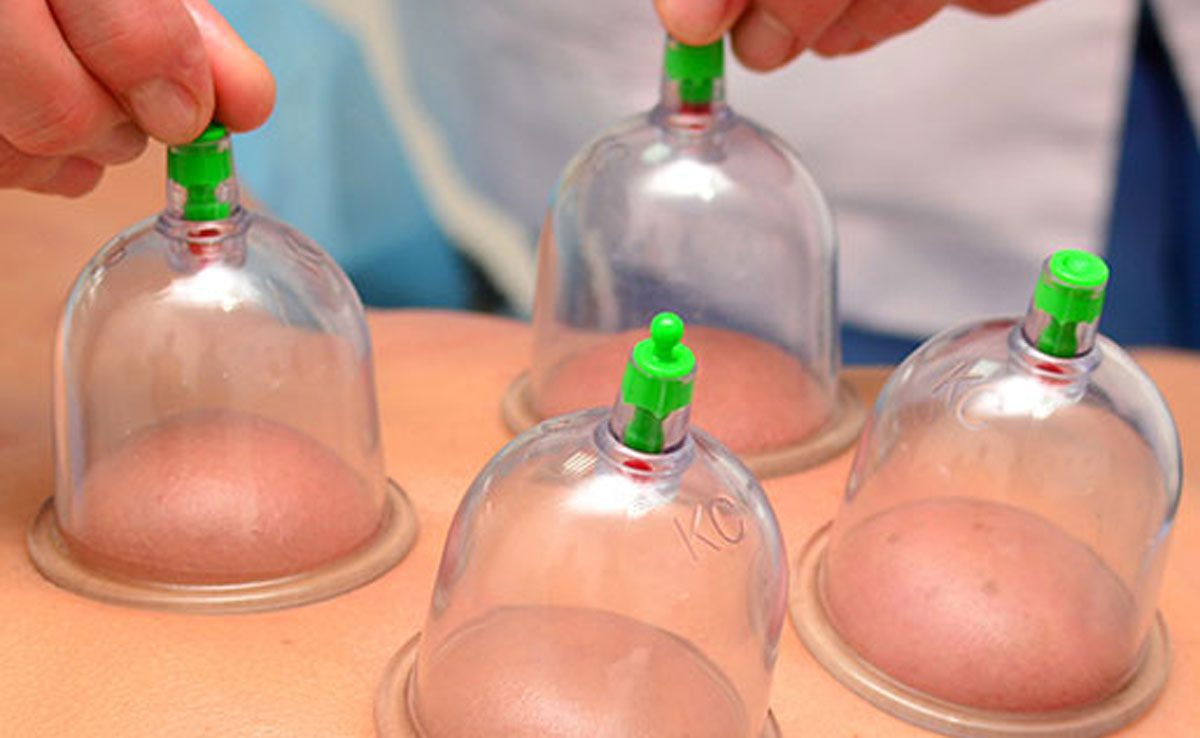 Important thing related to cupping therapy