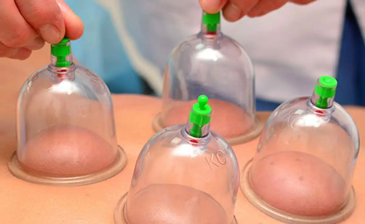 Important thing related to cupping therapy