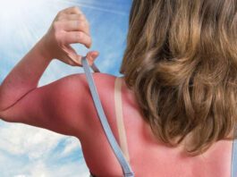 Some ways to avoid sunburn