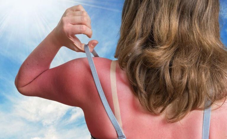 गर्मियों में Sunburn से कैसे बचें