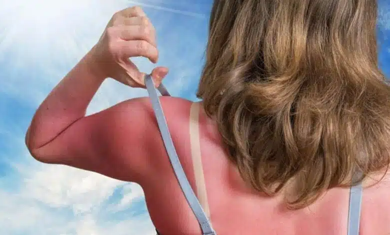 Some ways to avoid sunburn