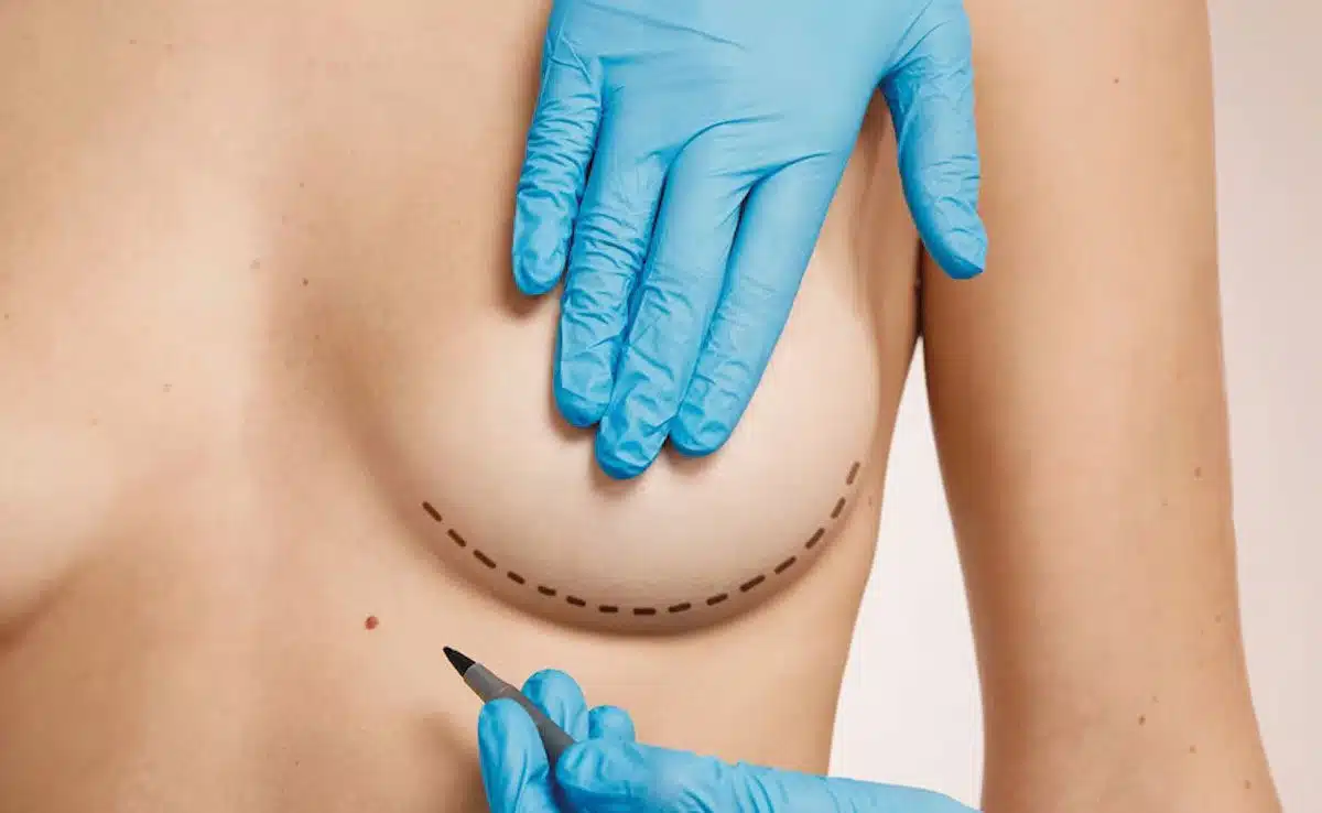 Benefits and Side Effects of Breast Reduction Surgery