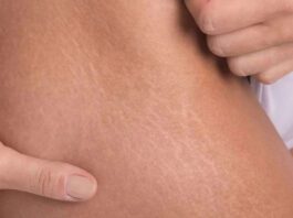 How to use castor oil to treat stretch marks?