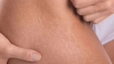 How to use castor oil to treat stretch marks?