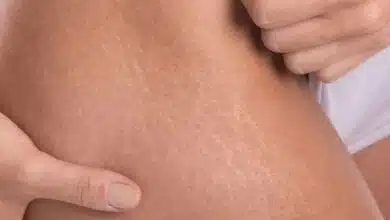How to use castor oil to treat stretch marks?