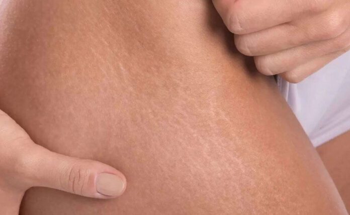 How to use castor oil to treat stretch marks?