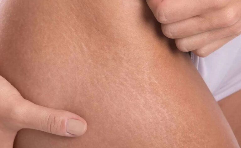 Stretch Marks के इलाज लिए कैस्टर ऑयल का इस्तेमाल कैसे करें?