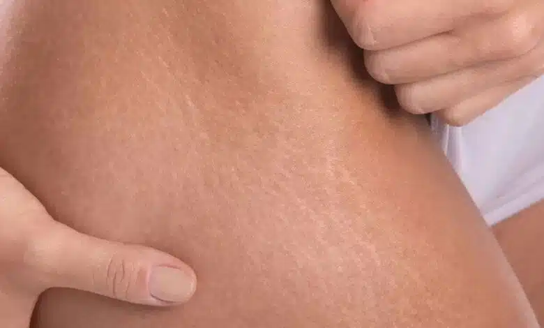 How to use castor oil to treat stretch marks?