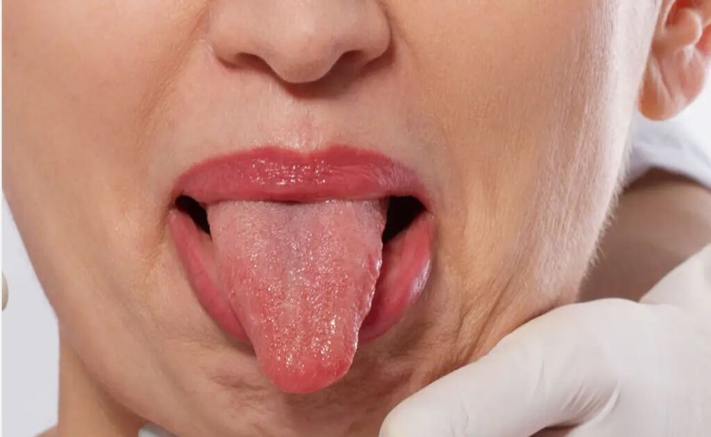 Home remedies to cure Burnt Tongue quickly